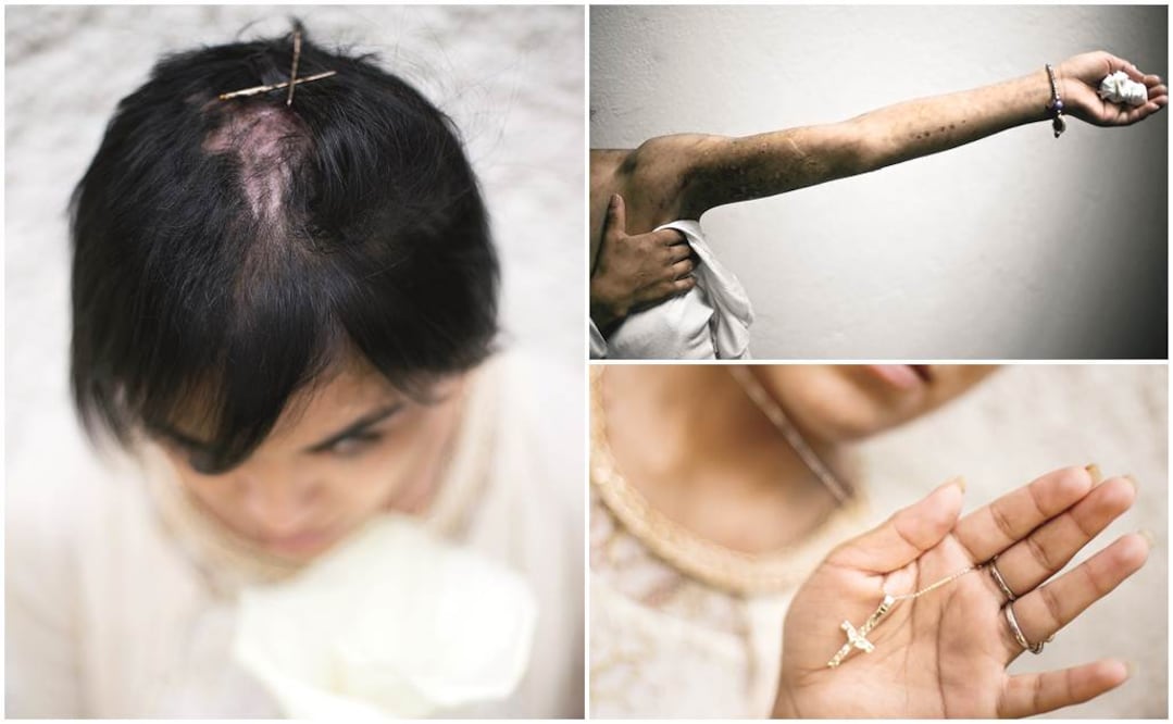 A un mes de haber escapado de sus verdugos, Zunduri confía en borrar las huellas de la tortura que sufrió de la cabeza a los pies. Ahora vive en un albergue de alta seguridad (Foto: Arturo Bermúdez)