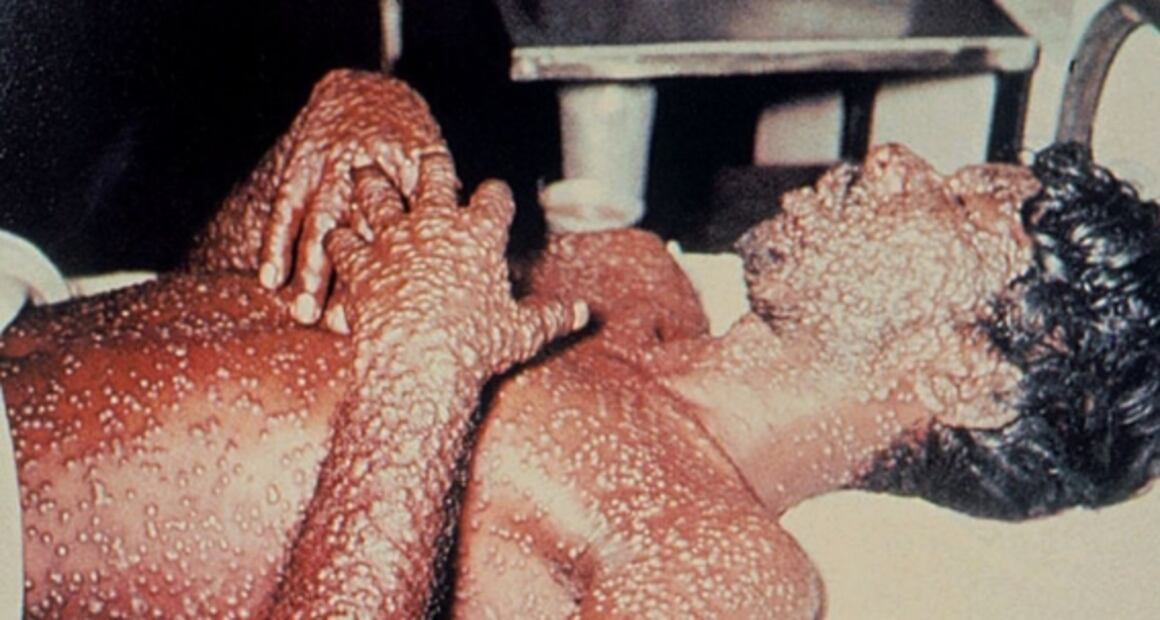 Viruela del mono: en qué se diferencia de la devastadora viruela humana