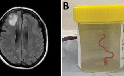 Médicos hallan lombriz intestinal de 8 cm en el cerebro de una mujer: "estaba vivo y retorciéndose"