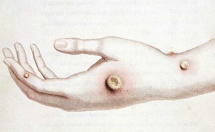 Portugal confirma cinco casos de viruela del mono; en España hay ocho sospechosos