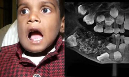 Niño con inusual condición es sometido a cirugía: le extraen 526 dientes