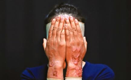 Cámara de Diputados avala tipificar los ataques con ácido como violencia física 