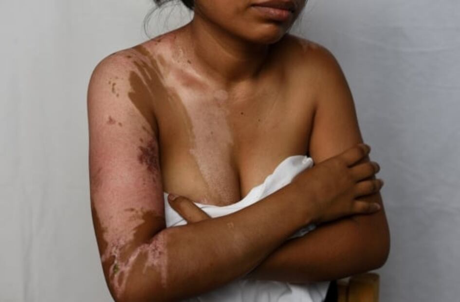 Agresor la quemó con agua; "no es delito", le dijeron en el MP