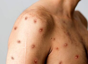 Ante viruela del mono falta intensificar acciones