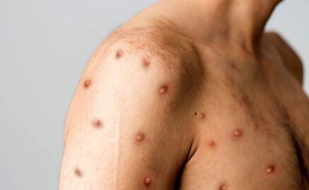 Ante viruela del mono falta intensificar acciones