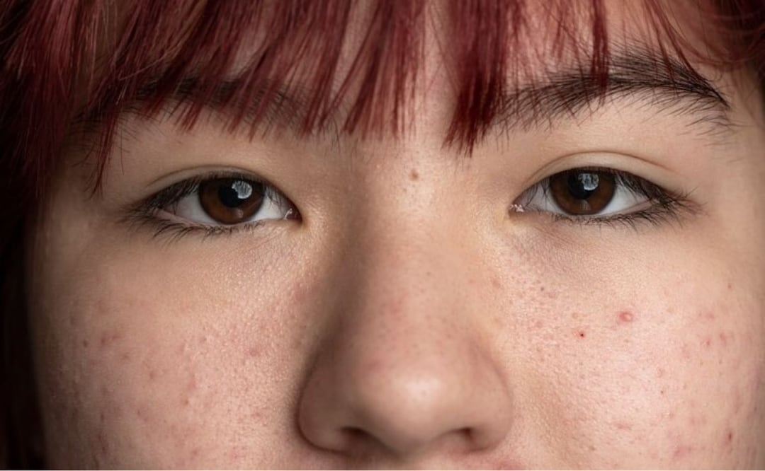 Qué significan los puntos rojos en la piel. Fuente: Freepik