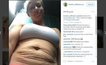 Ex conejita de "Playboy" muestra sus estrías