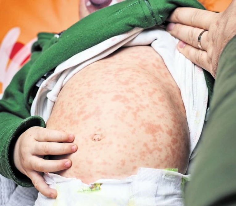 Confirman nuevos casos de sarampión en municipio indígena de Morelos; entidad registra 25 contagios en lo que va del año. Foto: ESPECIAL.