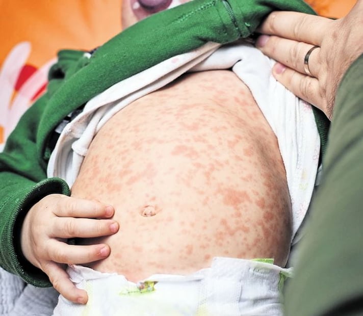 Menor contagiado de sarampión. Entre los síntomas están fiebre, catarro, inflamación de la mucosa nasal, conjuntivitis, sarpullido de color rojo (roncha o mancha) y las manchas de Koplik (puntos blancos al interior de la boca); en un estado más grave puede haber ceguera, bronconeumonía, diarrea o encefalitis Foto: ESPECIAL