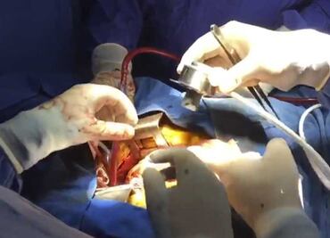 IMSS coloca con éxito un corazón artificial, el tercero en su historia