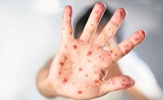 Sarampión en el mundo: ¿qué está provocando el repunte de contagios?; esto dice la UNAM