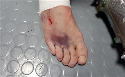 Así quedó el pie de Kutepov después del partido frente a Croacia