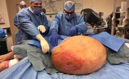 Médicos extraen un tumor de más de 60 kilos a una mujer