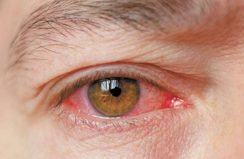 Machado Domínguez destacó que la prevención de esos males es crucial, sobre todo en la conjuntivitis, la cual se combate con una correcta higiene de manos. Foto: Archivo EL UNIVERSAL