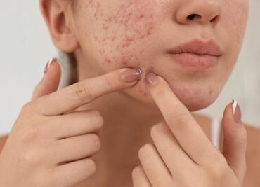 Un estudio confirmó que vemos con mayor desprecio a las personas con acné