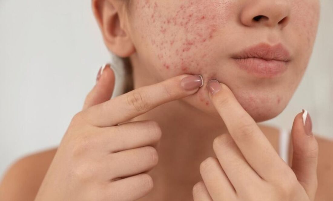 El desafío de la sociedad hacia las personas con acné. Fuente: Freepik.