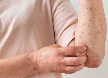 Primer caso de Viruela del Mono en Coahuila, importado por una mujer de Toluca, Estado de México