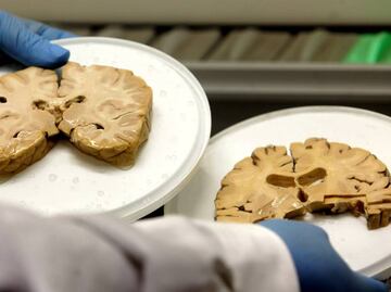 Identifican mecanismo clave en formación de tumores cerebrales