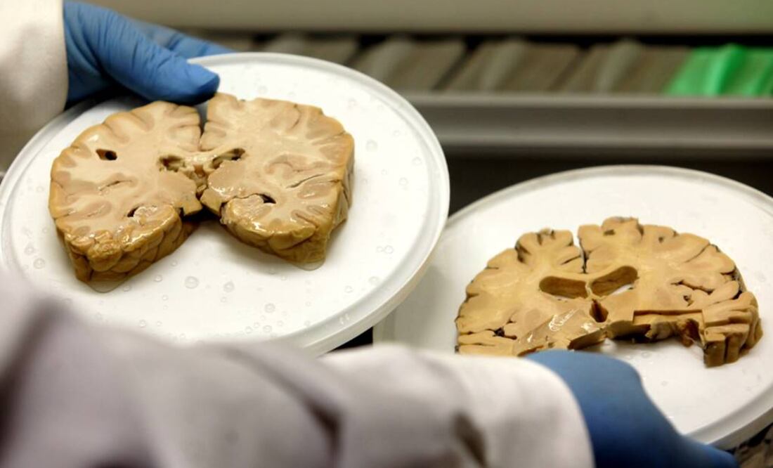 El descubrimiento tiene "importantes implicaciones clínicas" al abrir "un nuevo camino terapéutico para tratar esta devastadora enfermedad". Foto: Archivo