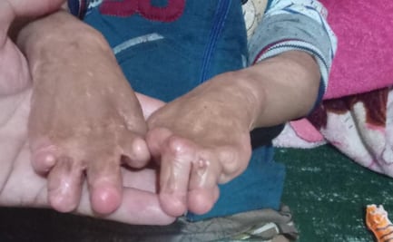 “Chuchito” y su papá reman contracorriente para salir adelante; piden apoyo para el niño, tiene quemaduras en todo su cuerpo