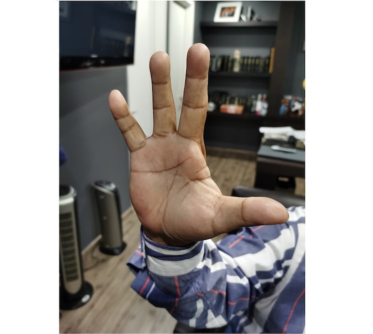 Trabajadores conocen de al menos otros 3 casos en los que el sindicato los obligó a accidentarse. Fotos: Especiales