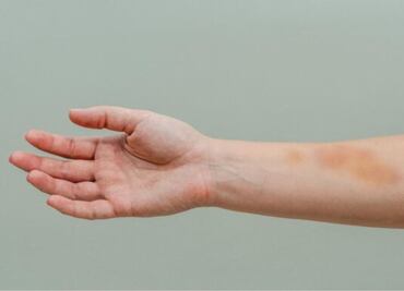 Esta es la vitamina que le falta a tu cuerpo cuando salen hematomas en tu piel