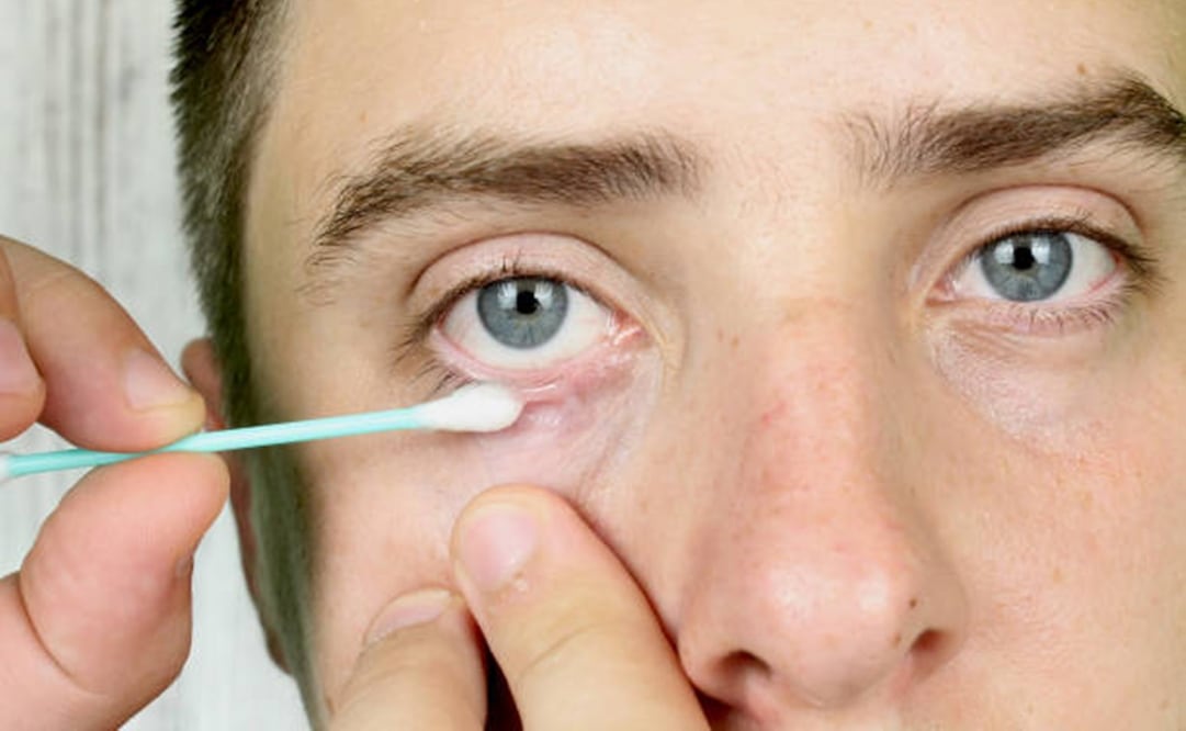 Los ácaros se pueden ver al microscopio a través del análisis de una pestaña. Foto: Pixabay