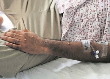 Viruela del mono: Suecia reporta primer caso de nueva subvariante de mpox