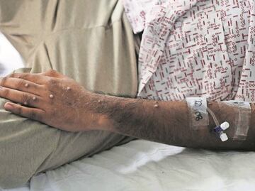 Brote de mpox, antes viruela del mono, en África incluye diferentes variantes y modos de transmisión: OMS