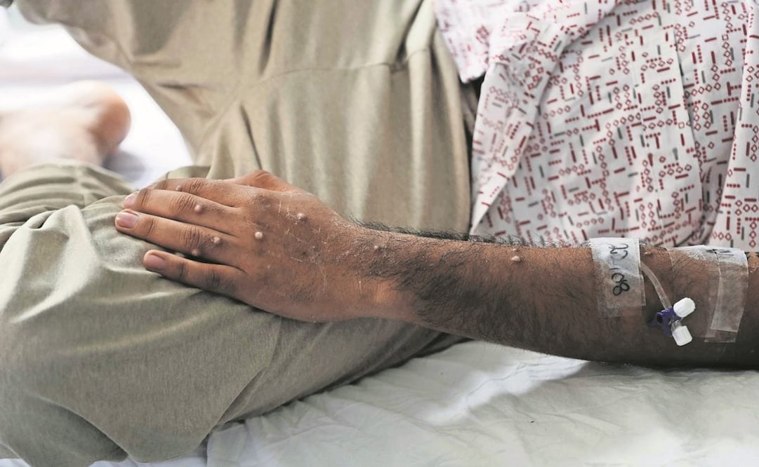 Brote de mpox pudo haberse evitado, de acuerdo con el doctor Dimie Ogoina. Foto: EFE