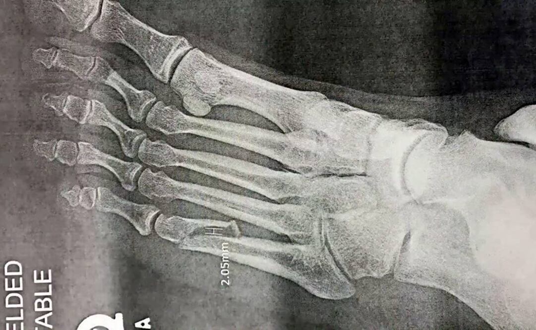 El cantante no podrá cargar peso sobre su pie izquierdo por al menos las próximas cuatro semanas. (FOTO: Archivo EL UNIVERSAL)