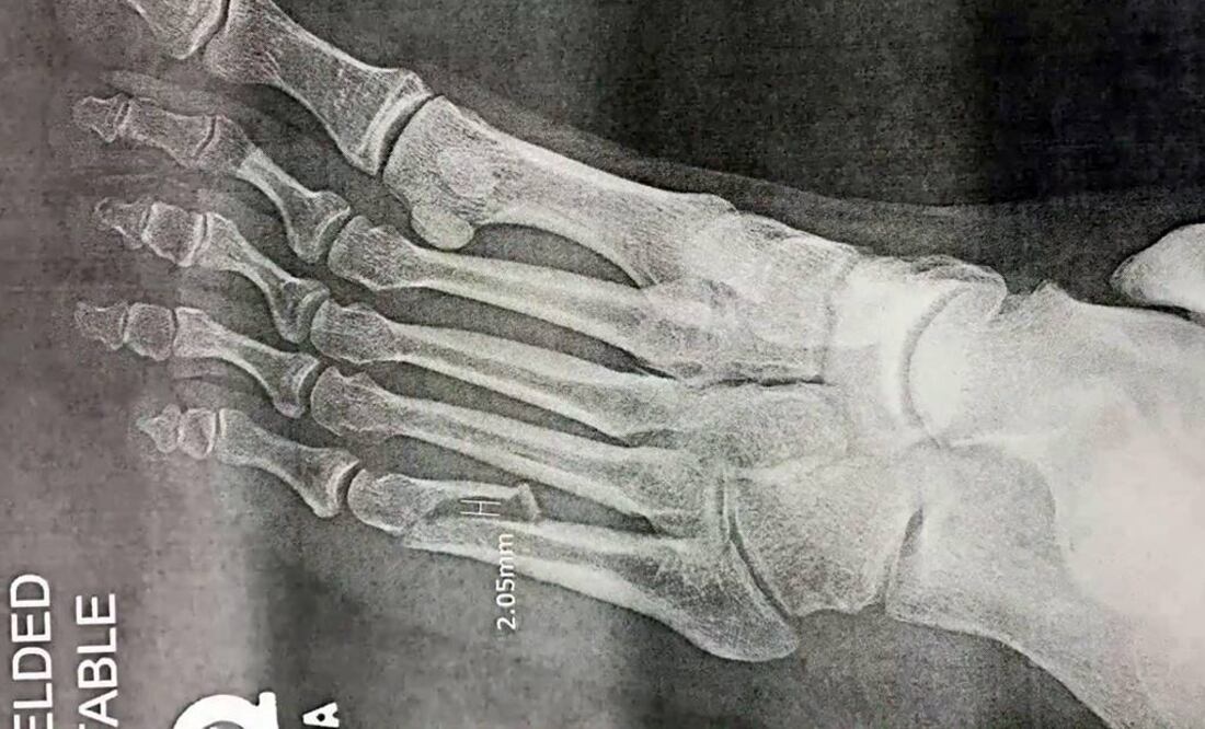 El cantante no podrá cargar peso sobre su pie izquierdo por al menos las próximas cuatro semanas. (FOTO: Archivo EL UNIVERSAL)