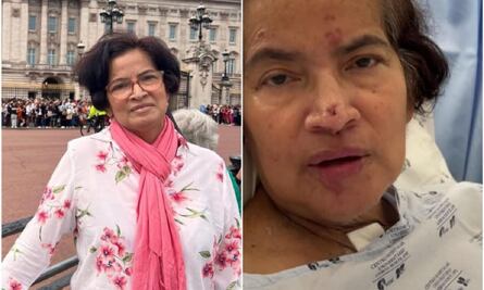 Colombiana a la que le amputaron las manos por una bacteria aprende a comer por su cuenta