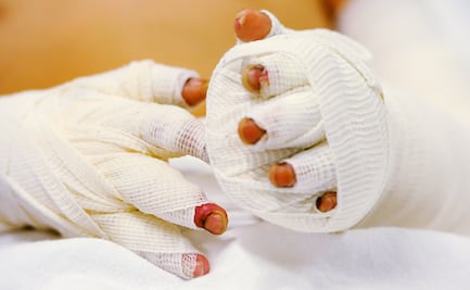 Explosión de pirotecnia deja 3 niños lesionados en Iztapalapa