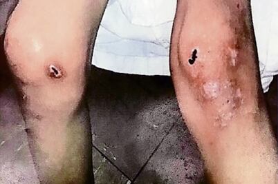 Menor torturada por abuela necesita 5 cirugías