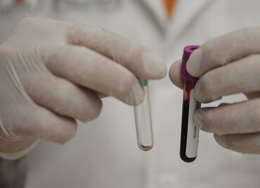 Día Mundial de lucha contra el VIH: Cómo afecta el SIDA el sistema inmunológico