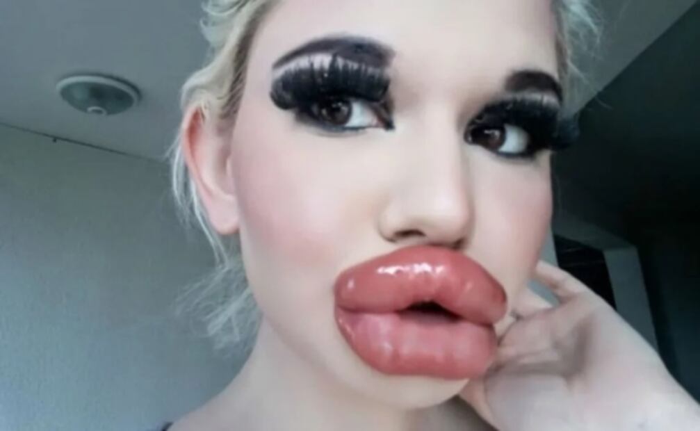 Se aplica 30 inyecciones en los labios, quiere ser una Barbie