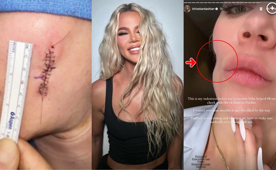 Hace unos meses le fue extirpado una parte del melanoma que Khloé Kardashian tenía en una de sus mejillas.
Fotos: Instagram