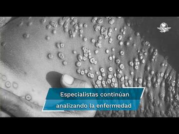 Viruela del mono: ¿es una enfermedad de transmisión sexual? 