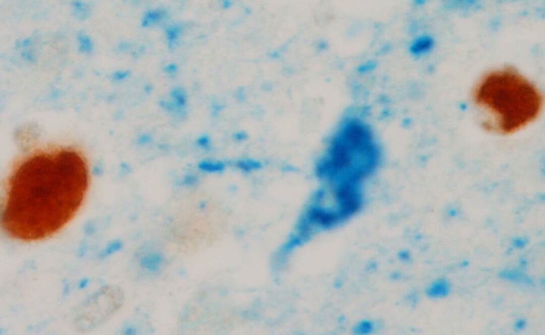 Una de las señales tempranas que alerta sobre el desarrollo de esta enfermedad es la aparición de fragmentos de beta-amiloides en el cerebro. Foto: Archivo