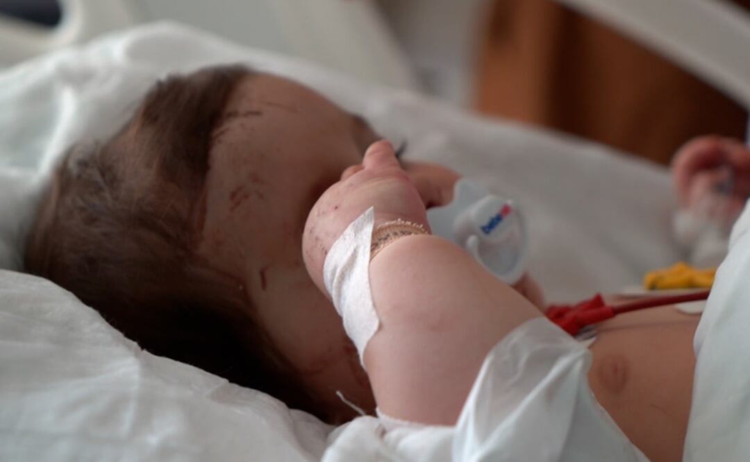 Esta bebé de seis meses, cuya cara está cubierta de cicatrices, solo es conocida como "anónima" por su etiqueta. Foto: BBC