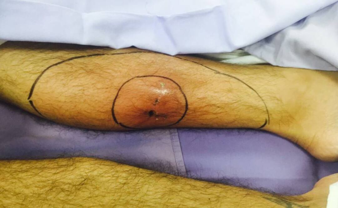 Fernández fue diagnosticado con gangrena gaseosa y tuvo que ser intervenido de emergencia. (FOTOS: Cortesía Star Productions)