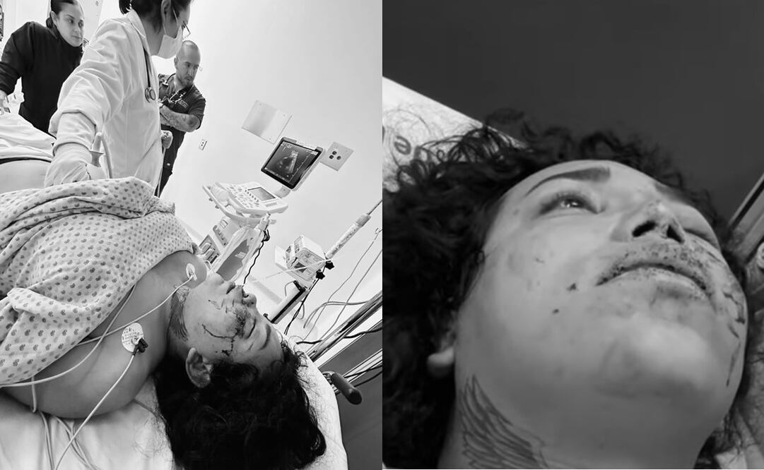 Paola Suárez, de "Las Perdidas" está a punto de perder uno de sus ojos. Foto: Captura de pantalla