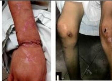 Niña torturada requiere 5 cirugías más para recuperar su rostro