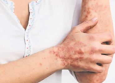 Detectan 13 nuevos casos de viruela del mono en Jalisco