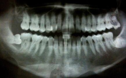 Enfermedades bucales podrían ocasionar cáncer de páncreas