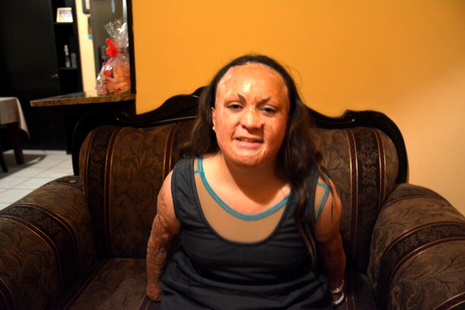 Alejandra es Alejandra Guadalupe, es una sobreviviente del incendio de la guardería ABC, en junio de 2009, Foto: Javier Escobar / EL Universal