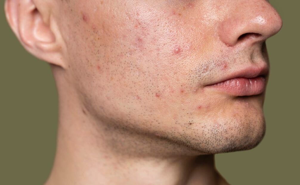 Los granos en la cara afectan el autoestima. Foto: Freepik