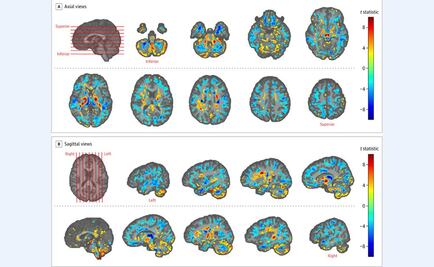 Misterio sobre dolencia de diplomáticos de EU en Cuba; sus cerebros tienen menos materia blanca