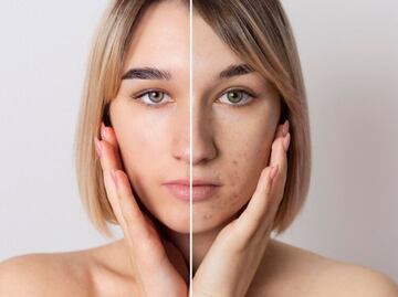 Descubre cómo eliminar el acné de tu piel